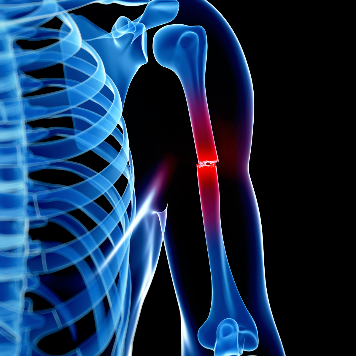 Why Was A Fracture Missed On An X Ray The Medical Consultant